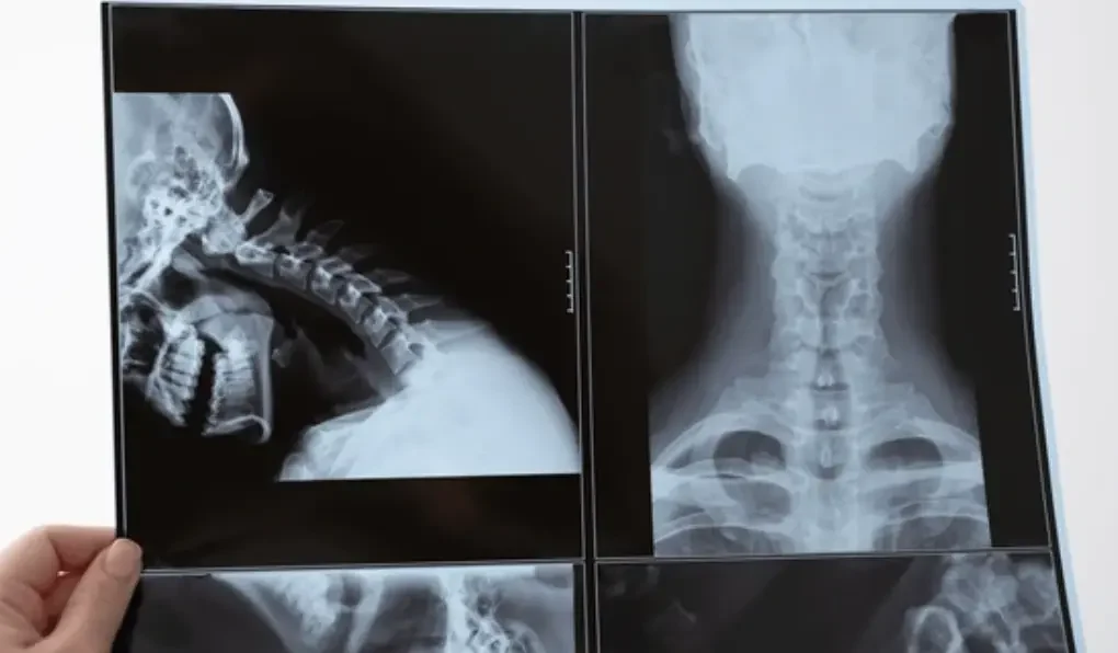 X-rays of the Spine, Neck or Back