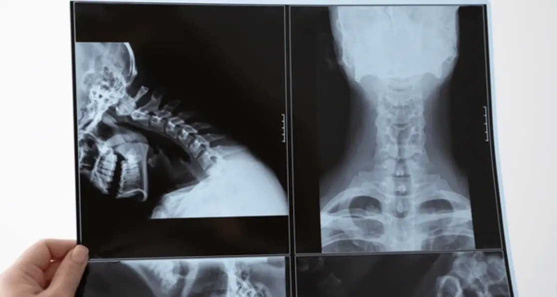X-rays of the Spine, Neck or Back